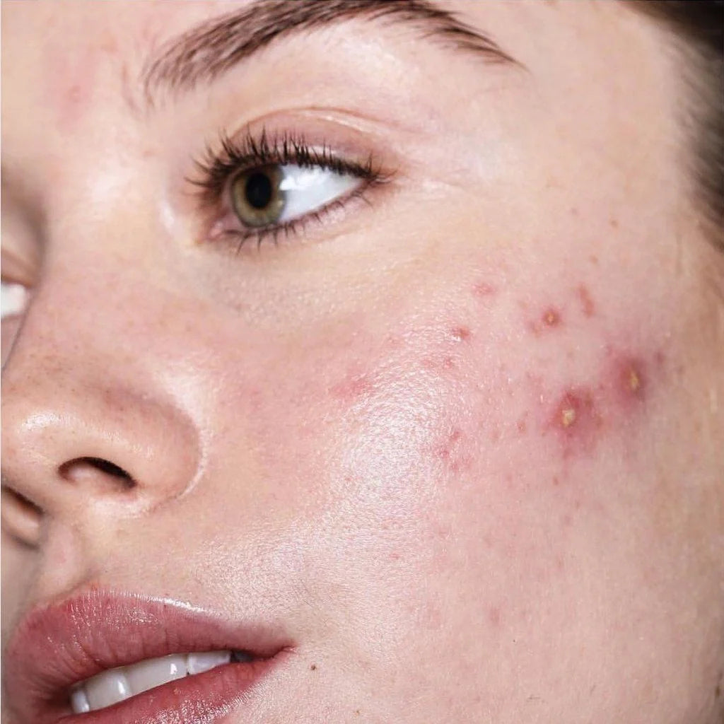 Acne Prone